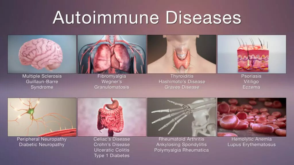 Autoimmune Disease and its Trigger's